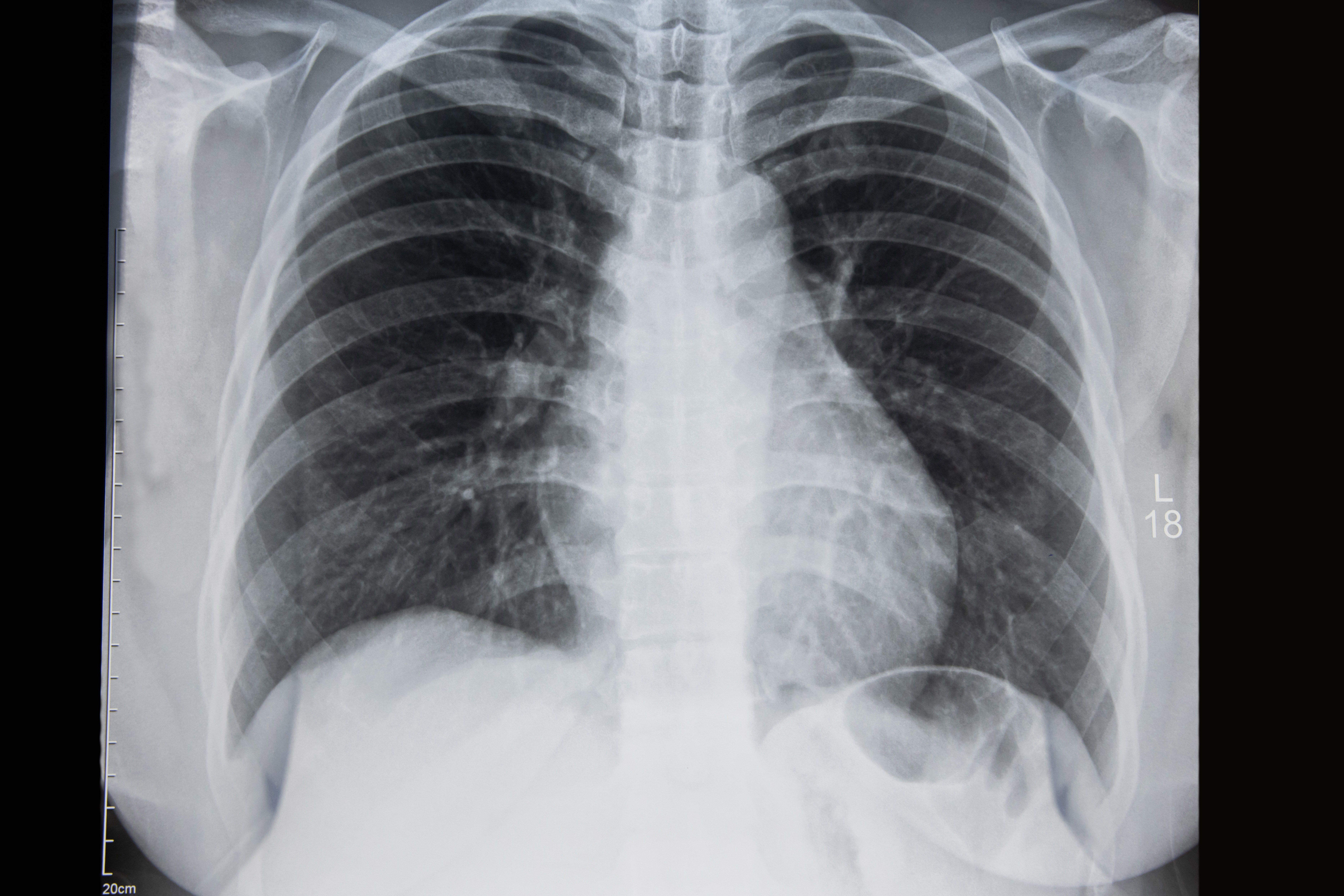 Lung Xray